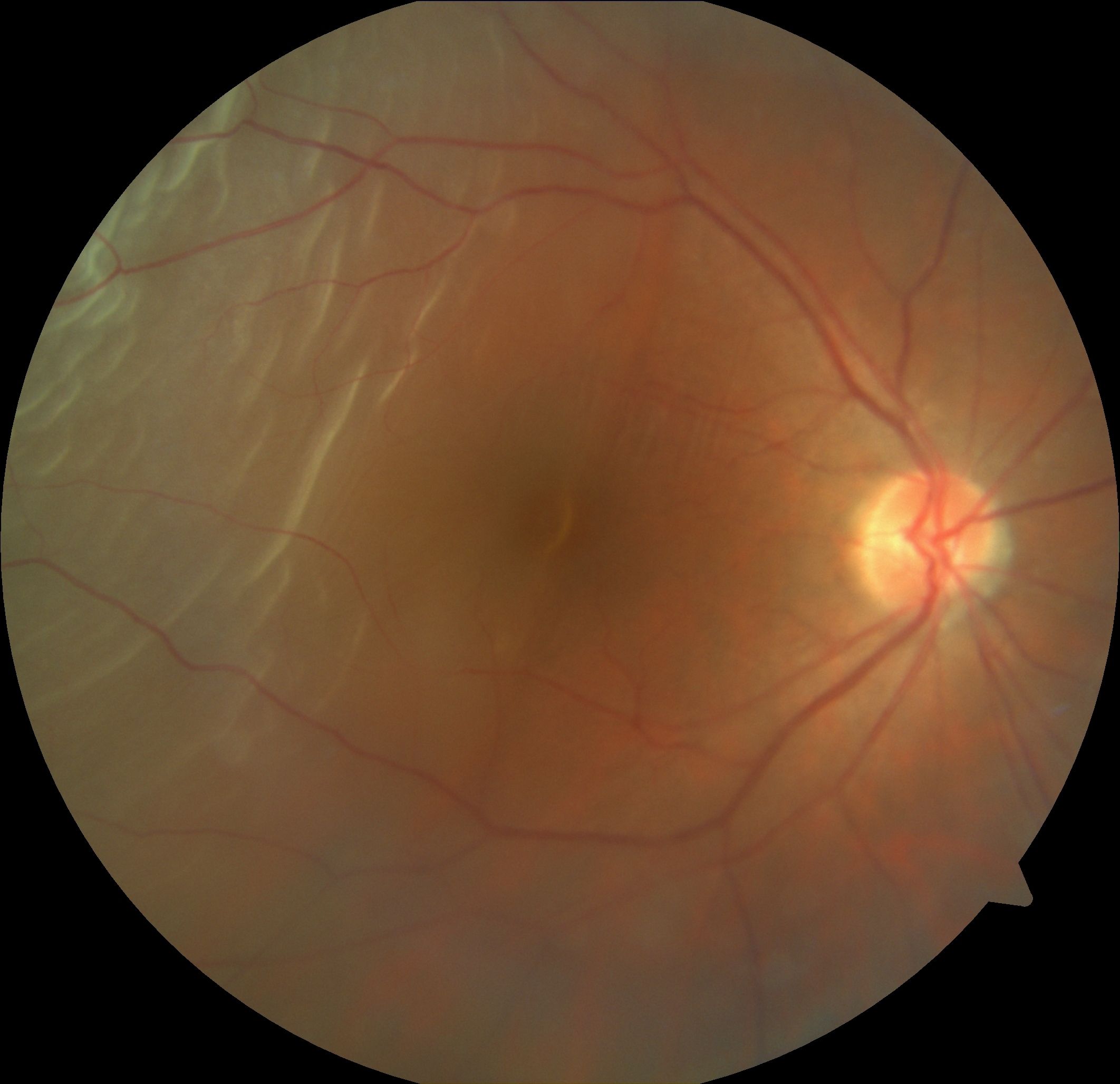 <p>Superotemporal Rhegmatogenous Retinal Detachment.&nbsp;</p>