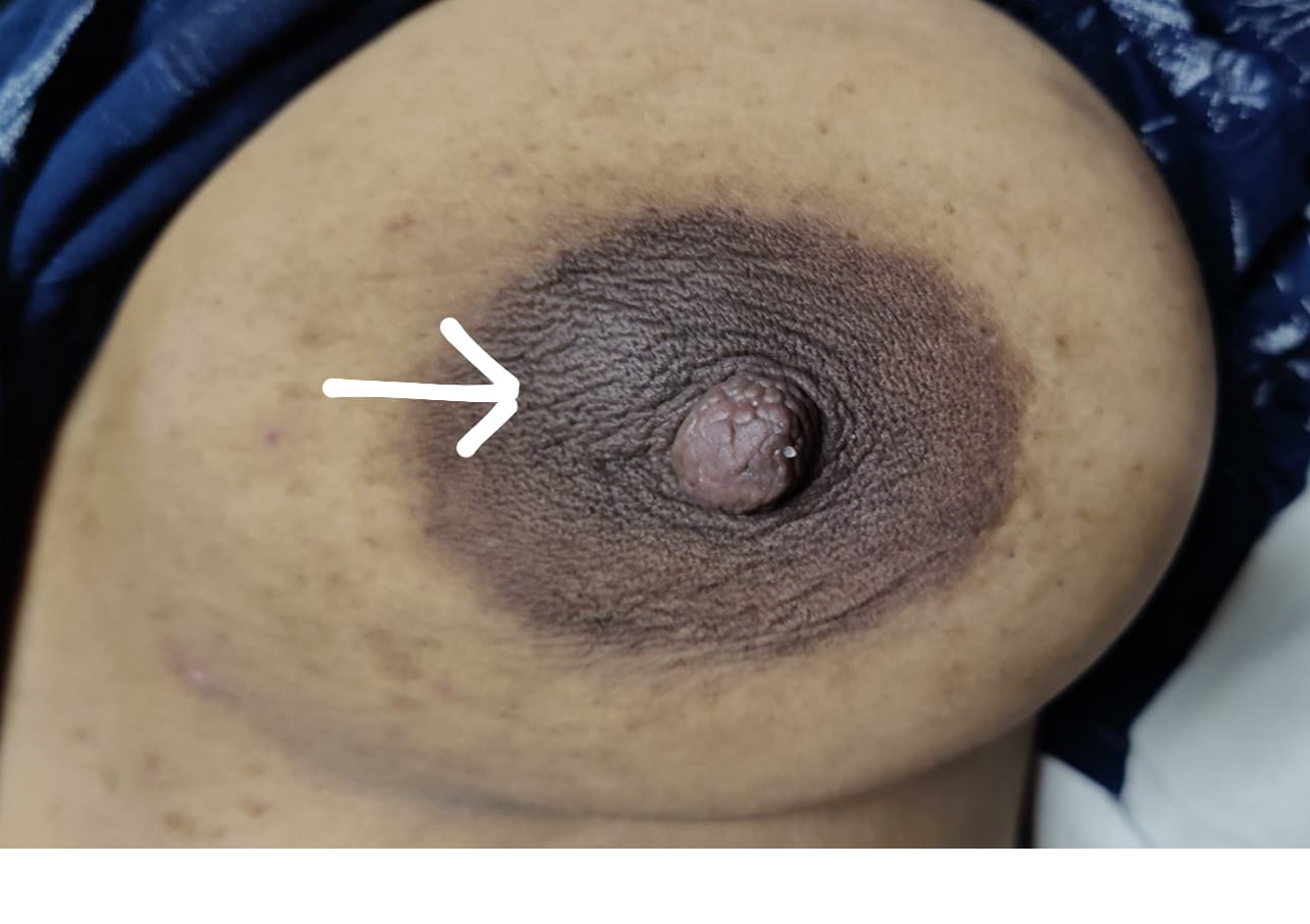 Galactocele in the retro-areolar region of the left breast