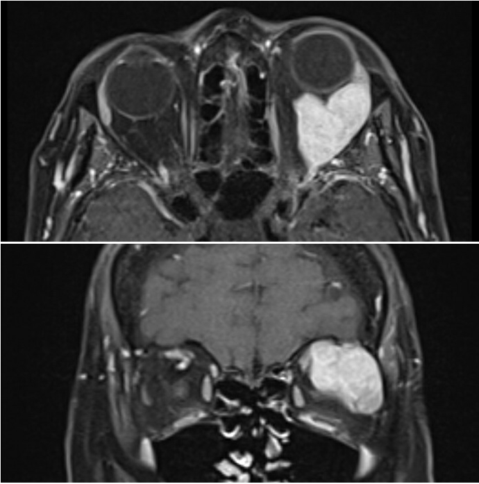 <p>Lacrimal Gland Malignancy