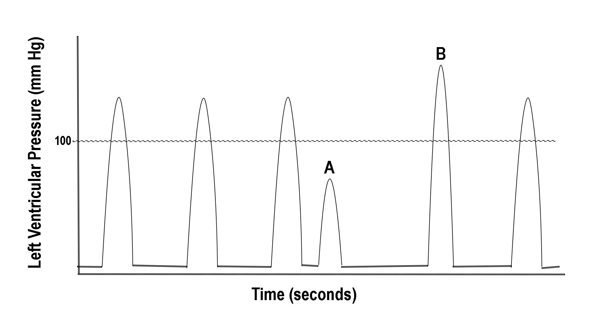 Postextrasystolic potentiation illustration