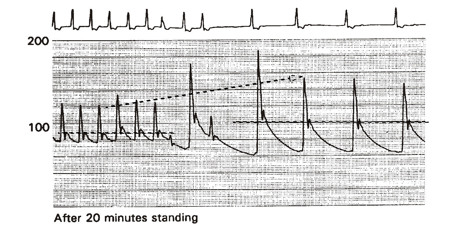 Effect of sudden heart rate decrease on blood pressure