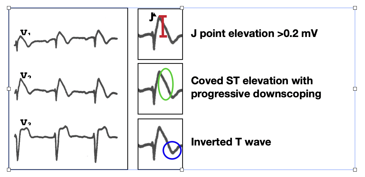 ECG features of Brugada's syndrome