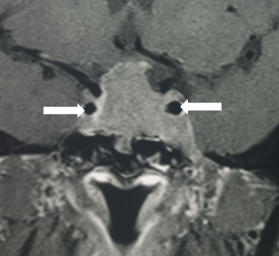 <p>Pituitary Macroadenoma Encasement of the Internal Carotid Artery