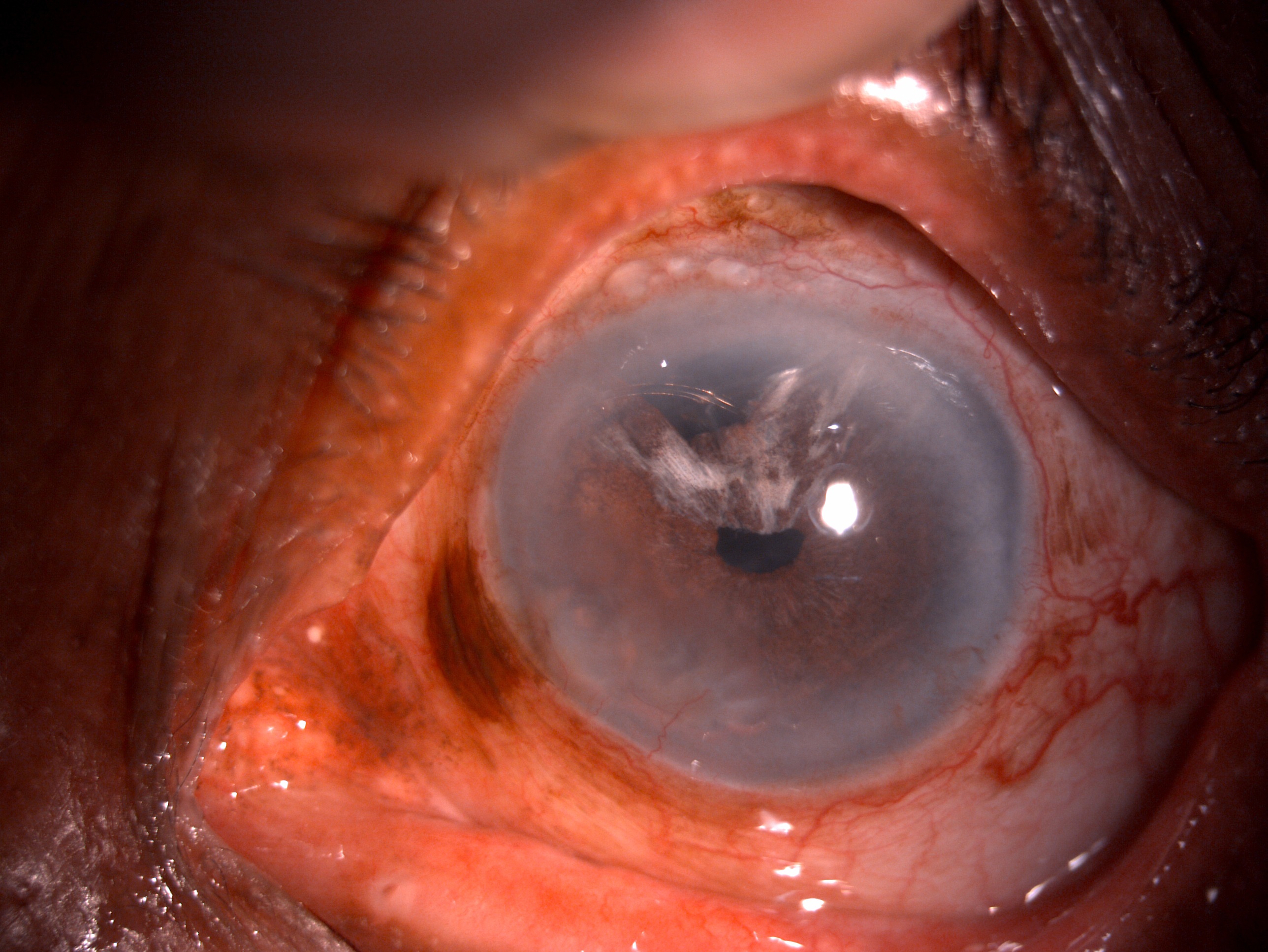 Slit lamp image of the patient depicting conjunctival congestion, superior two clock hour iridodialysis, iris chaffing and ha