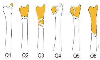 <p>Distal Ulna Fractures. AO classification system.</p>