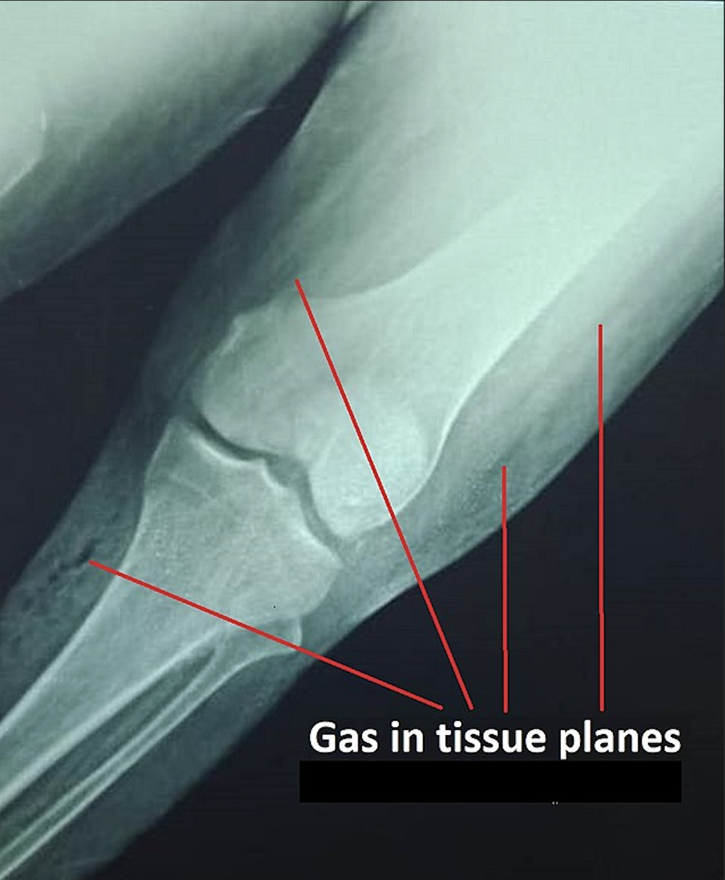 <p>Gas Gangrene. Plain x-ray showing gas in the tissue planes in a patient with gas gangrene.</p>