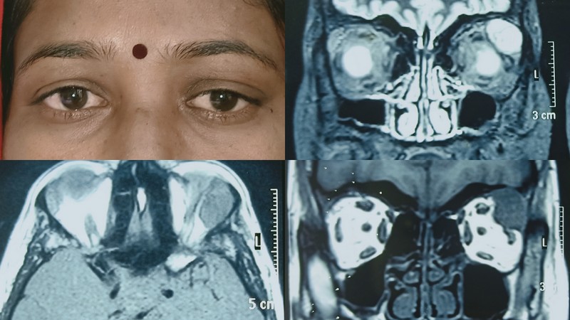 <p>Adenoid Cystic Carcinoma