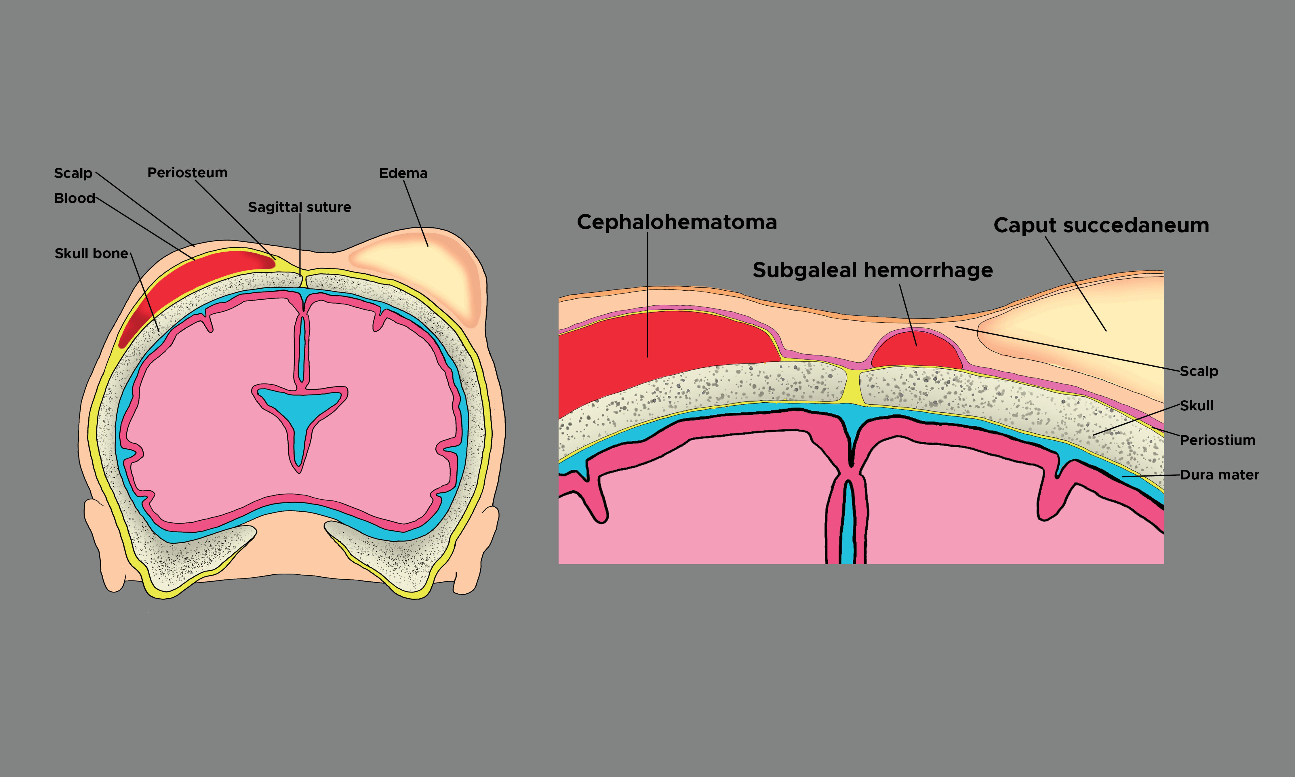 <p>Cephalohematoma