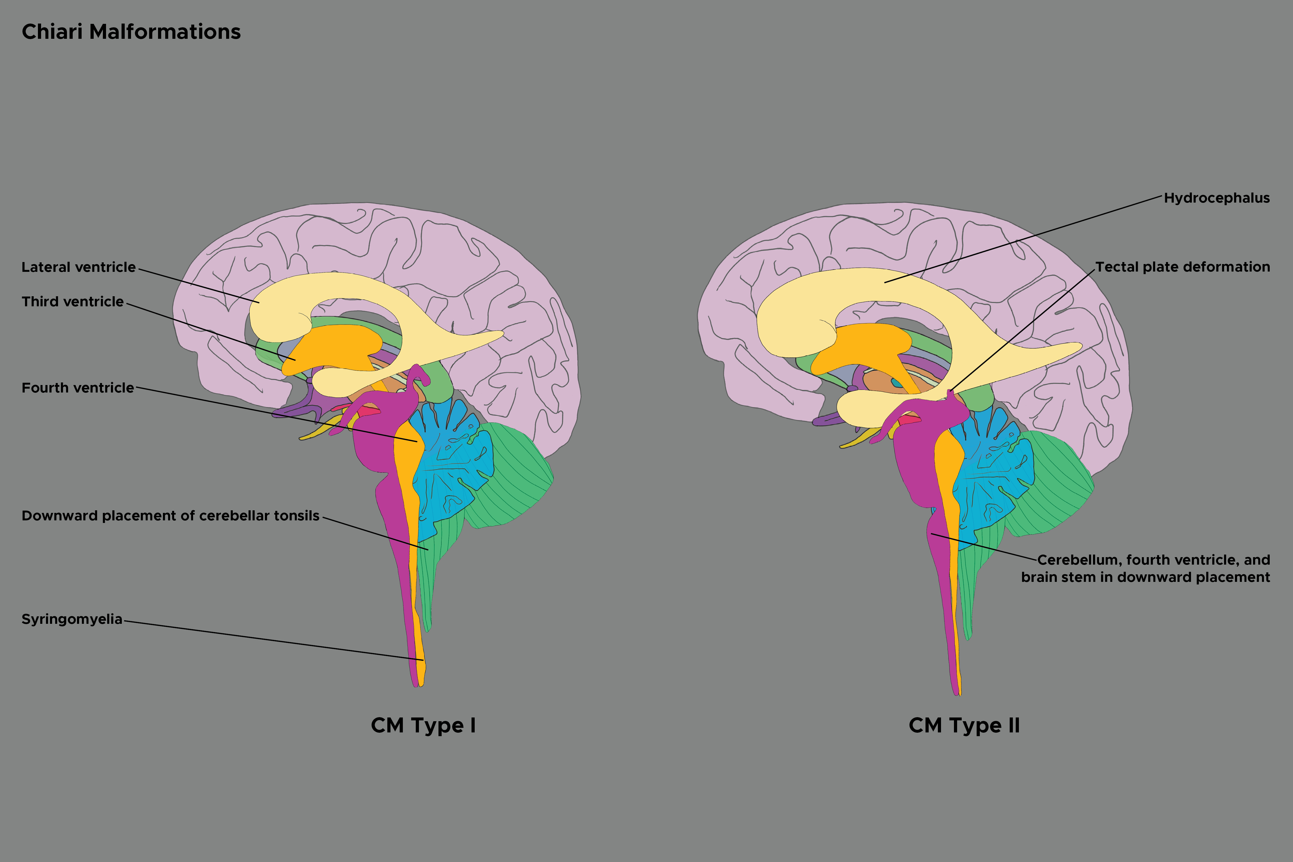 Illustration of Chiari Malformations. CM types I and II.