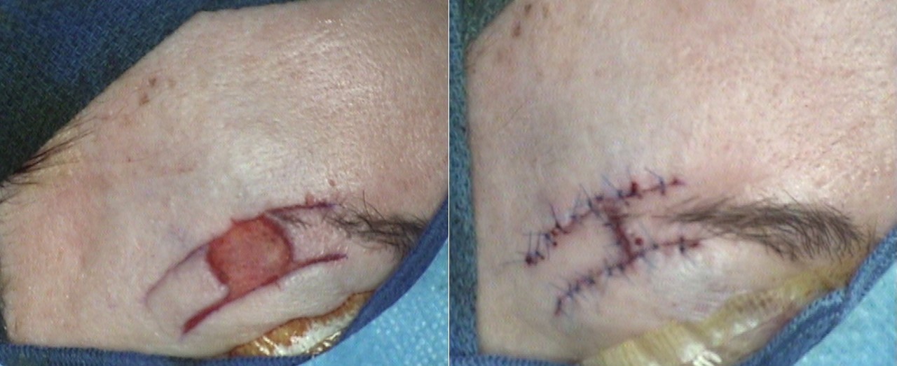 <p>O to H Bilateral Advancement Flaps to Close a Brow Defect
