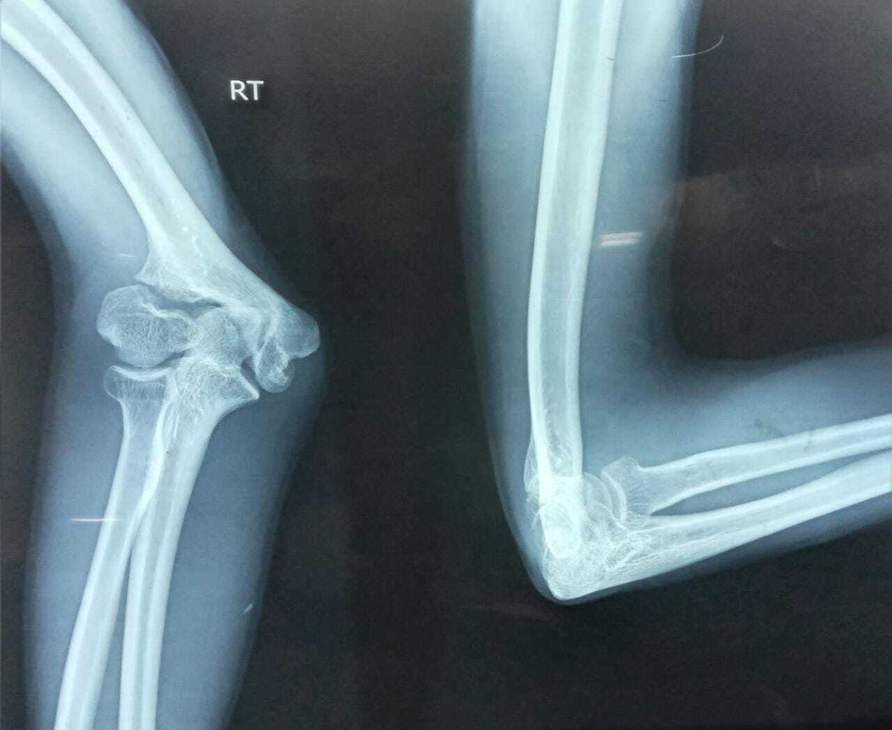 <p>Complications of a Lateral Humeral Condyle Fracture