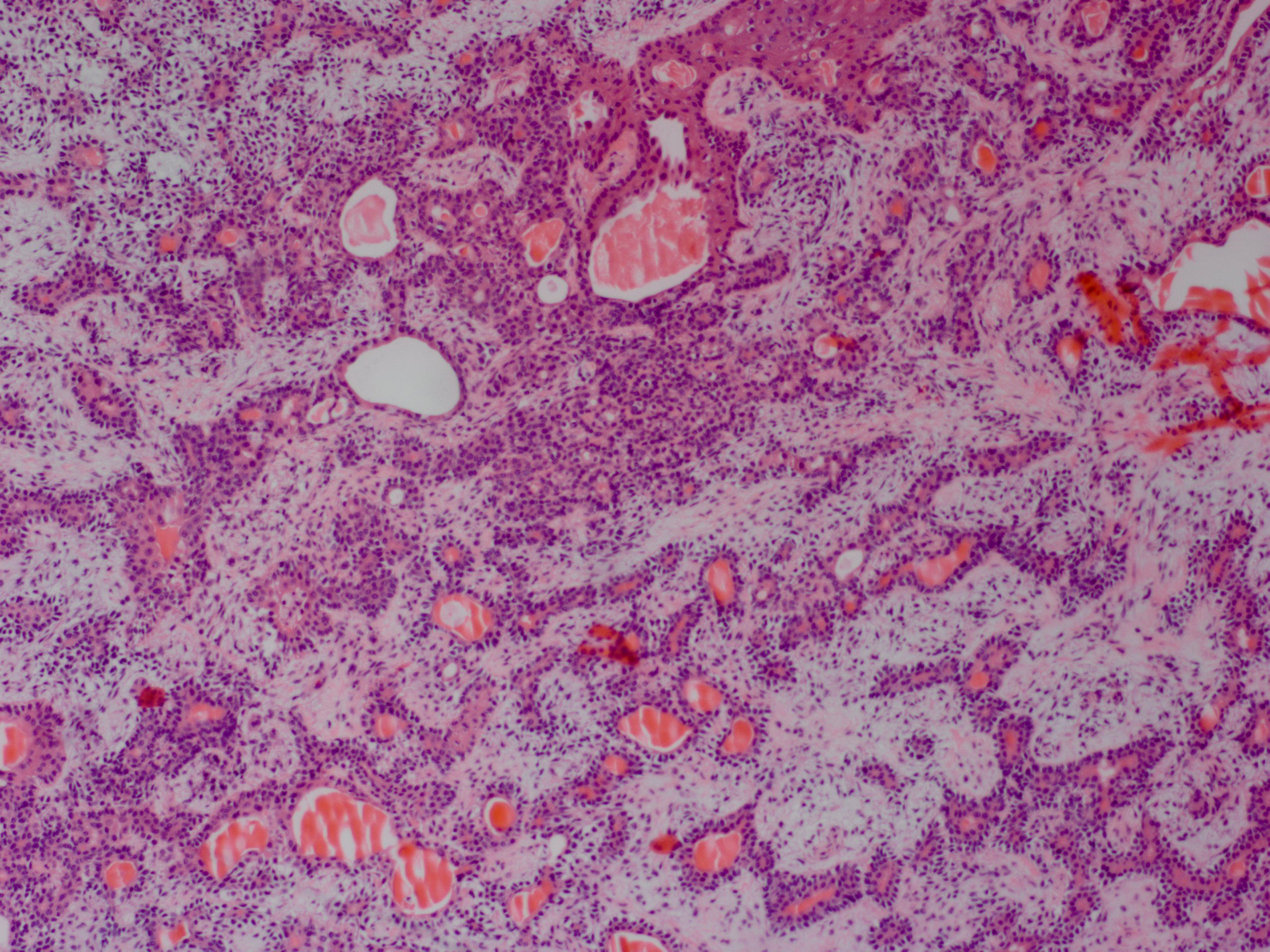 <p>Lacrimal Gland Pleomorphic Adenoma 25&times;</p>