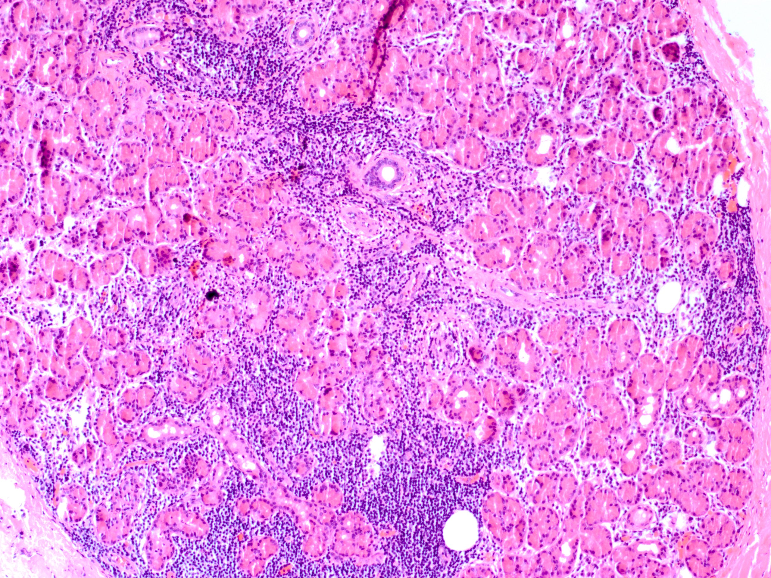 Lacrimal Gland Chronic Dacryoadenitis 25x