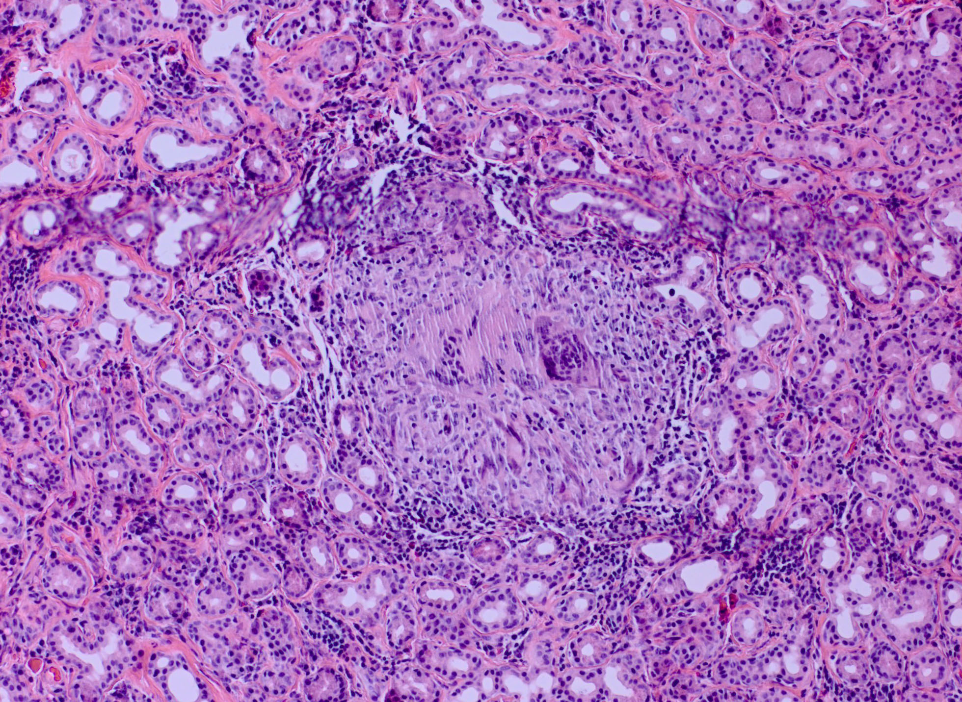 Lacrimal Gland Sarcoid 25x