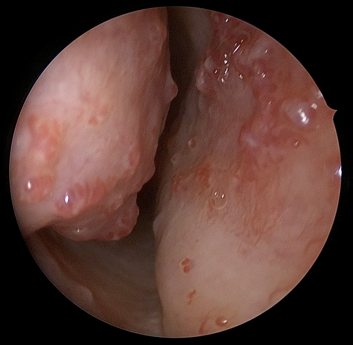 <p>Telangiectasia in Nasal Cavity