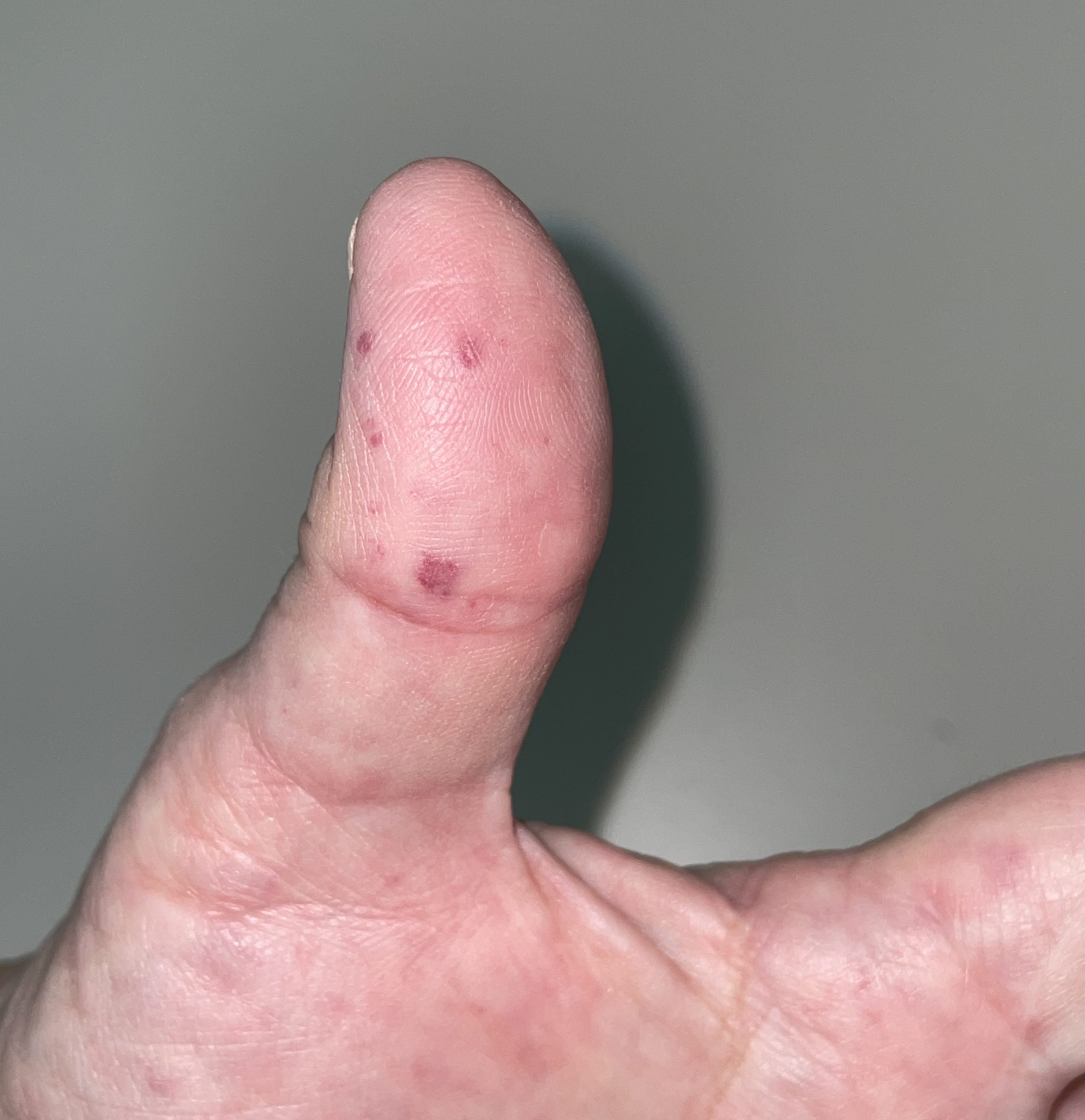 <p>Hereditary Hemorrhagic Telangiectasias on Thumb</p>