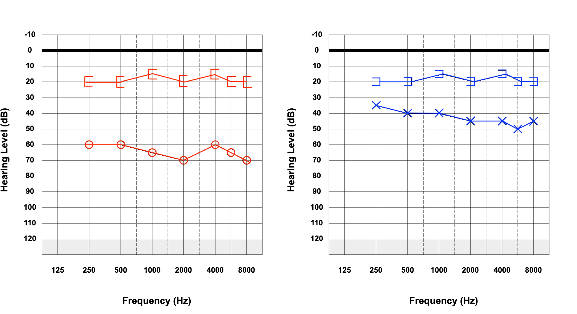 <p>Bilateral Conductive Hearing Loss