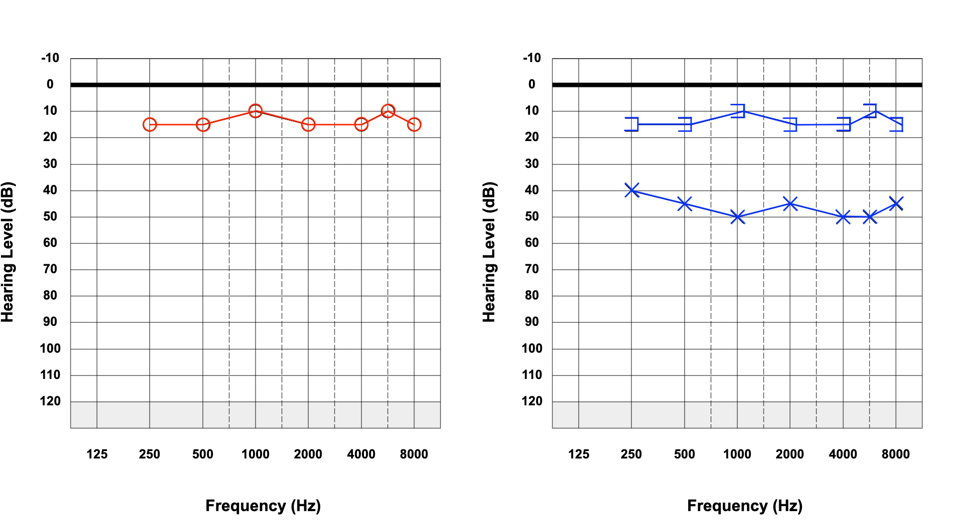 <p>Left-Sided Conductive Hearing Loss