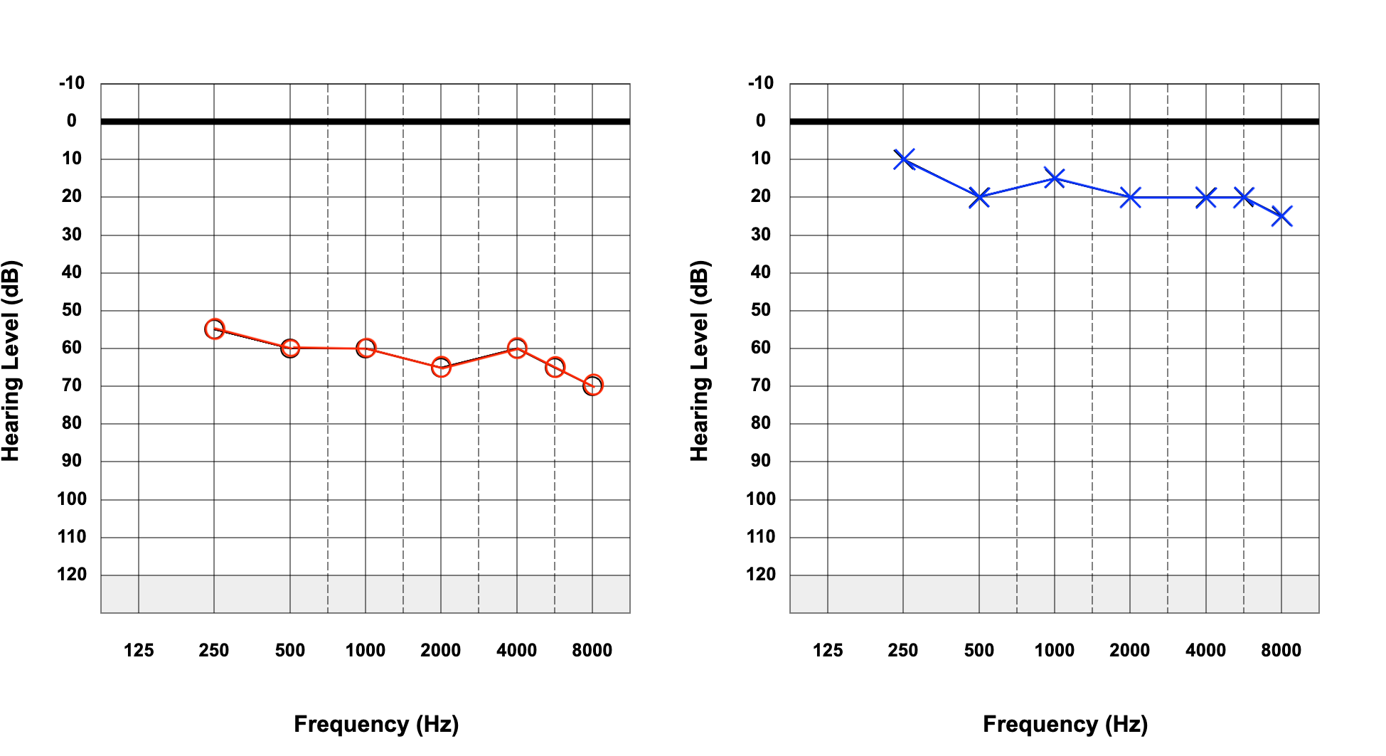 <p>Right-Sided Hearing Loss