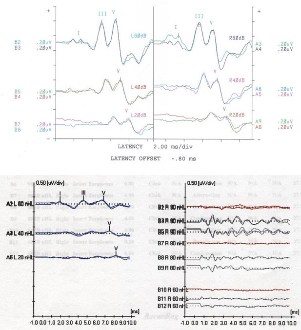 <p>Auditory Brainstem Response Test