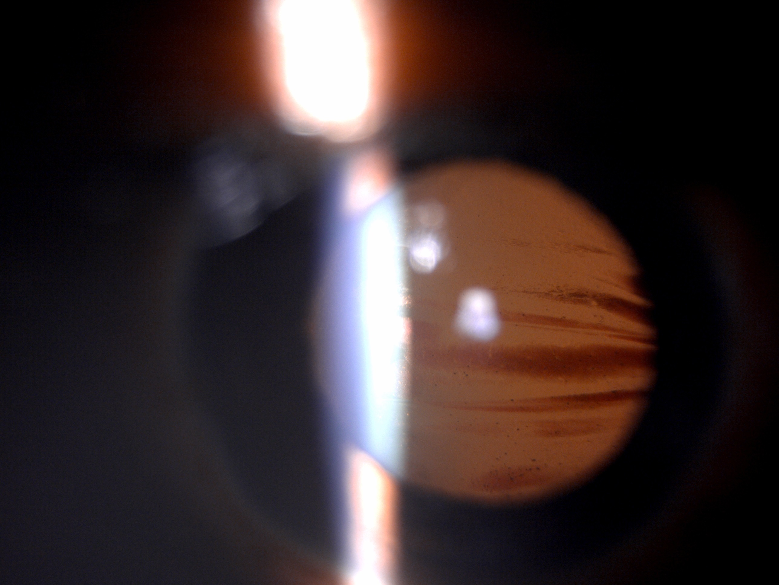 Slit lamp image of the patient with blunt ocular trauma (closed globe injury) depicting blood staining of the anterior lens c