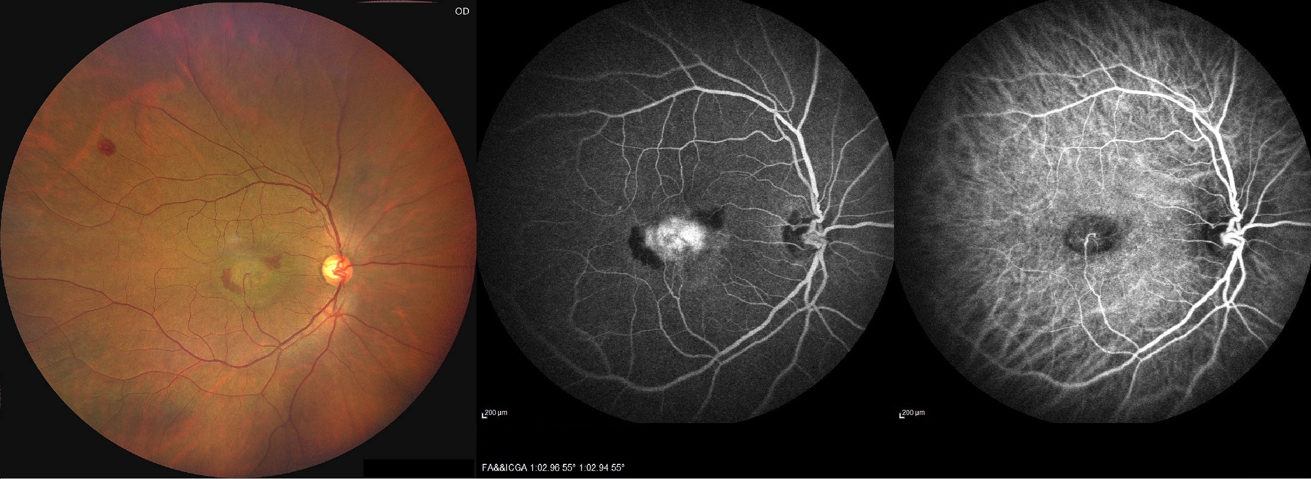 <p>Retinal Angiomatous Proliferation