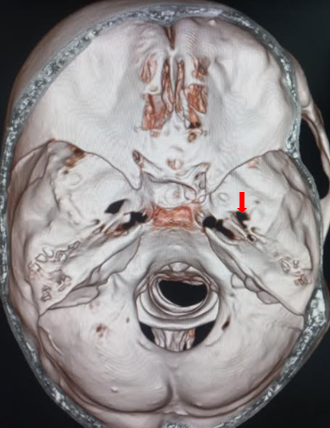 Foramen ovale