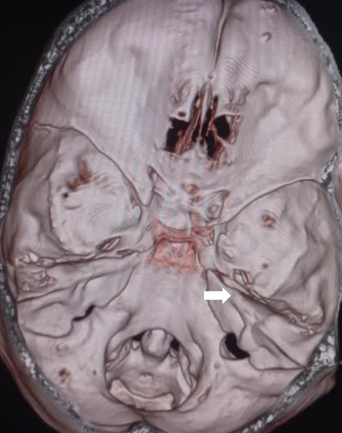 <p>Petrous Part Of The Temporal Bone. This&nbsp;arrow&nbsp;points to the petrous part of the temporal bone.</p>