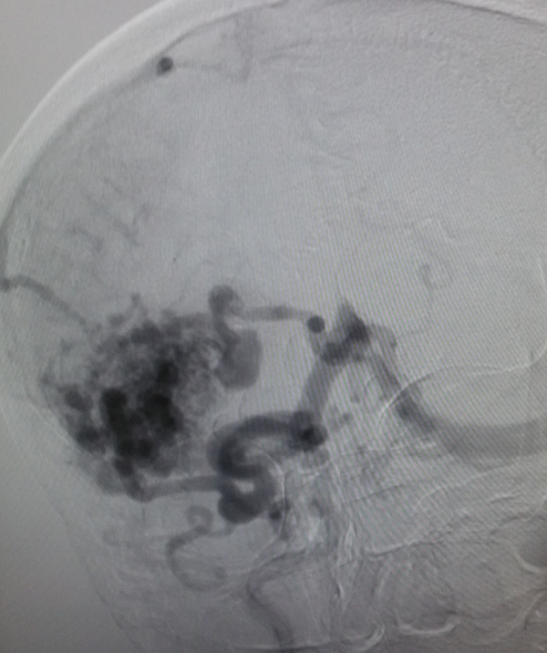 Angiogram showing nidus and the patterns of draining vein of the AVM