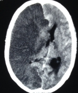 Gross midline shift in hemispheric infarction