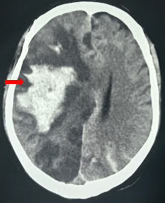 Gross midline shift in hemispheric infarction with hemorrhagic transformation