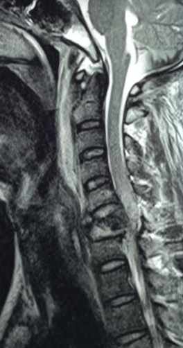 <p>Cord Compression Following Spinal Injury</p>