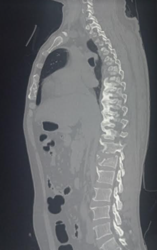 Ankylosing spondylitis