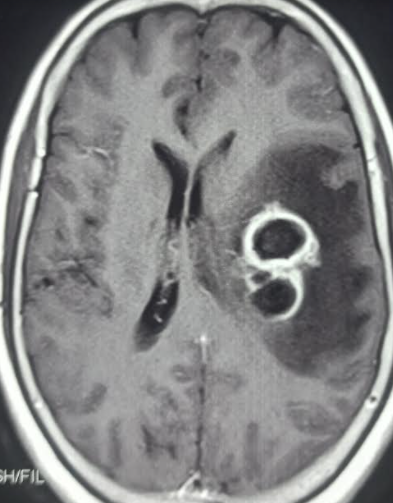 Brain abscess