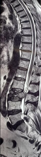 Vertebral compression fracture