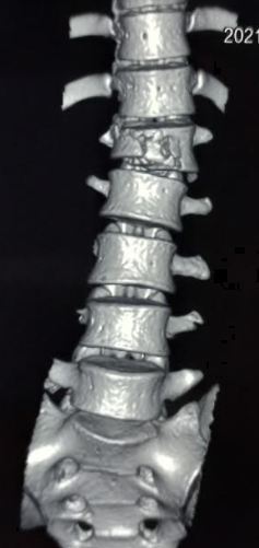 Vertebral compression fracture