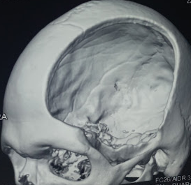 Decompressive hemicraniectomy