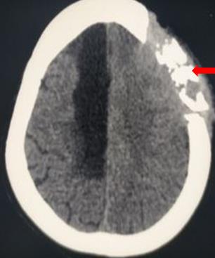 Osteomyelitis