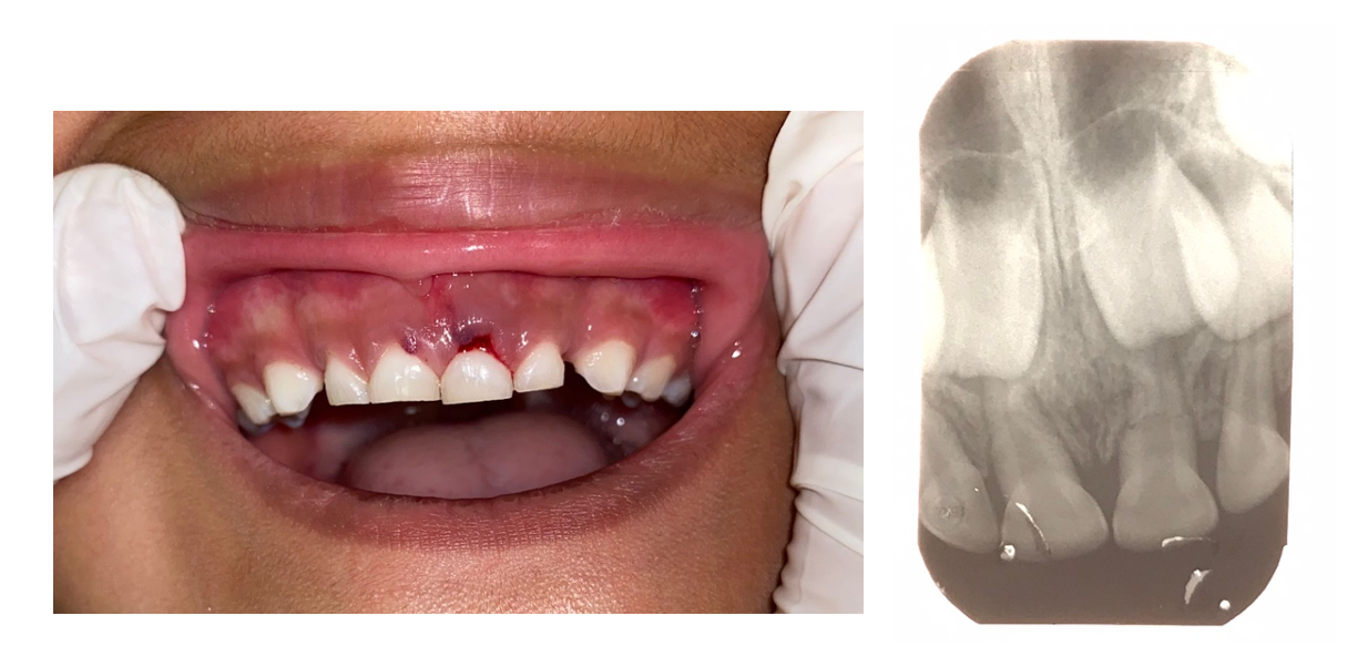 Clinical aspect of root fracture of 61. Periapical x-ray showing root fracture of 61.