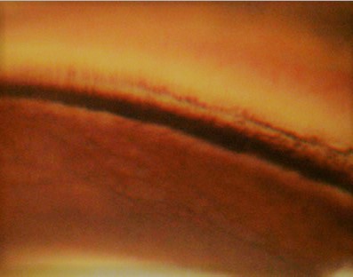 In Pigment Dispersion Syndrome (PDS) and/or Pigmentary Glaucoma (PG), pigment deposition can also be evident in TM when preforming gonioscopy, showing homogenous and full circumference increased pigmentation