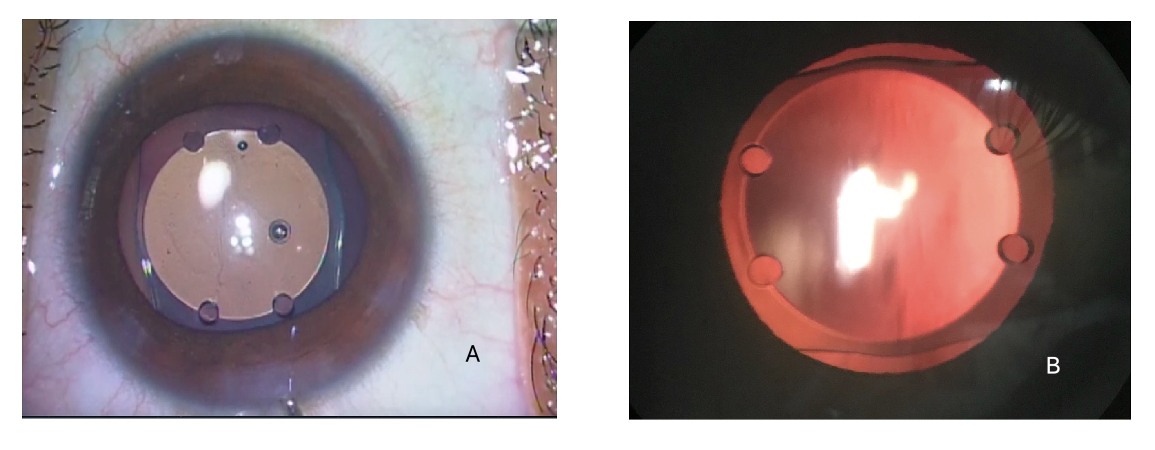 Phakic Intraocular Lens: A) Showing the intraoperative view 
                                            B) Showing the retr