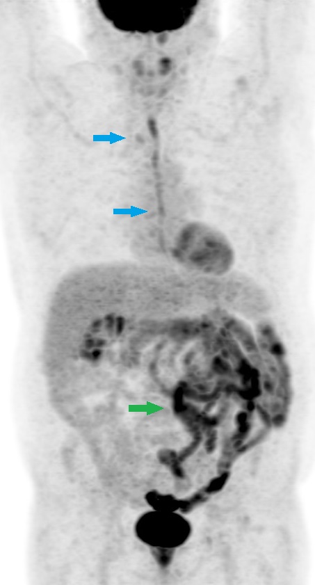 Figure 1: FDG PET/CT in a patient with dysphagia shows diffuse increased radiotracer uptake in the oesophagus consistent with oesophagitis (Blue arrows)