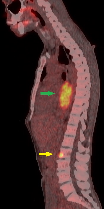 Figure 2: Sagittal fused FDG PET/CT image of a 56-year-old patient shows a highly FDG avid (SUV max 18) mass of mid-thoracic oesophagus (Green arrow) with solitary metastasis in L2 vertebral body (Yellow arrow)