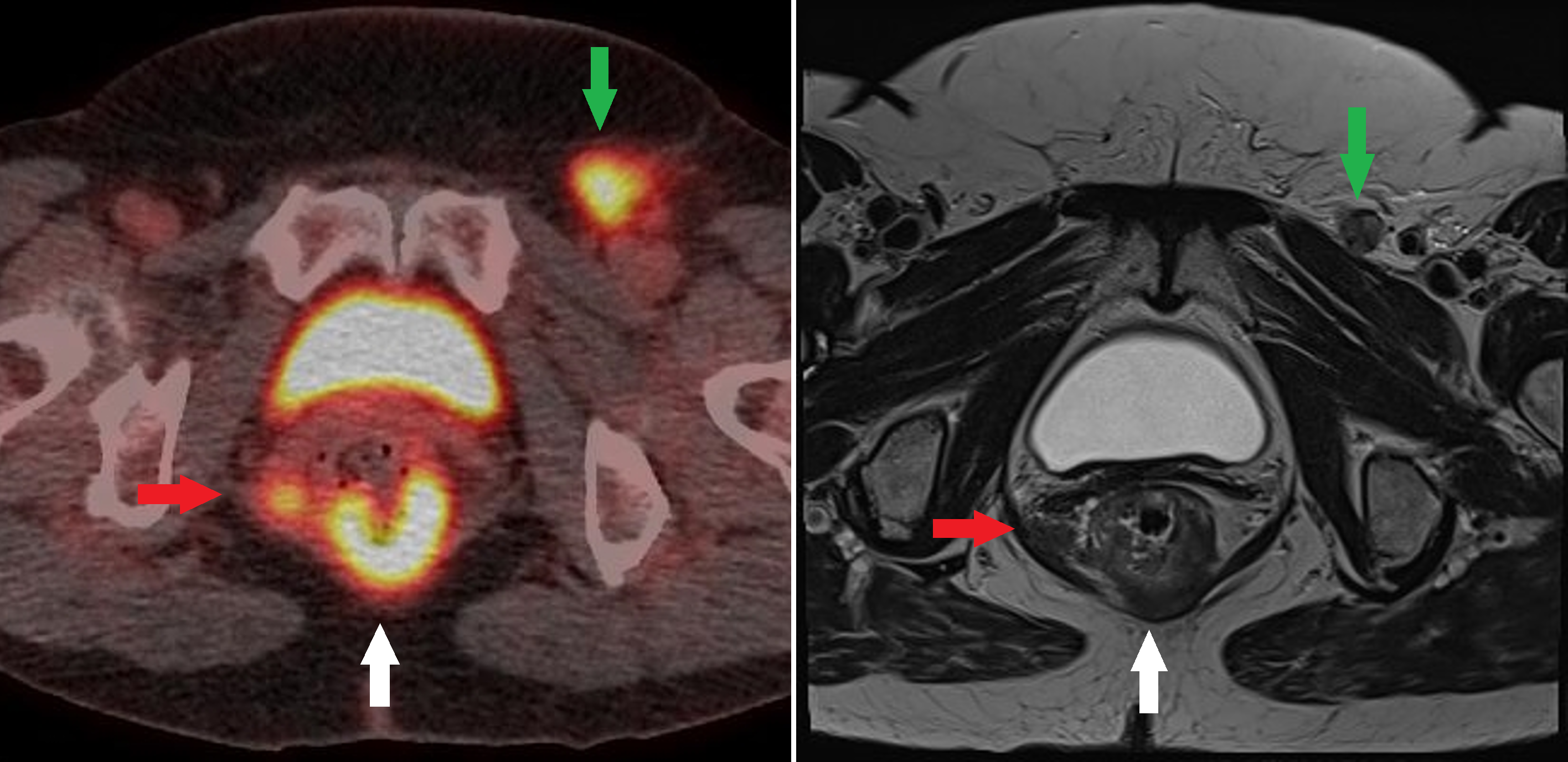 Figure 3:  Fused FDG PET/CT and T2 axial MRI images at the same level of an anorectal junction tumor (White arrow) with an FDG avid nodal deposit in the right mesorectum (Red arrow) and in the left groin (Green arrow)