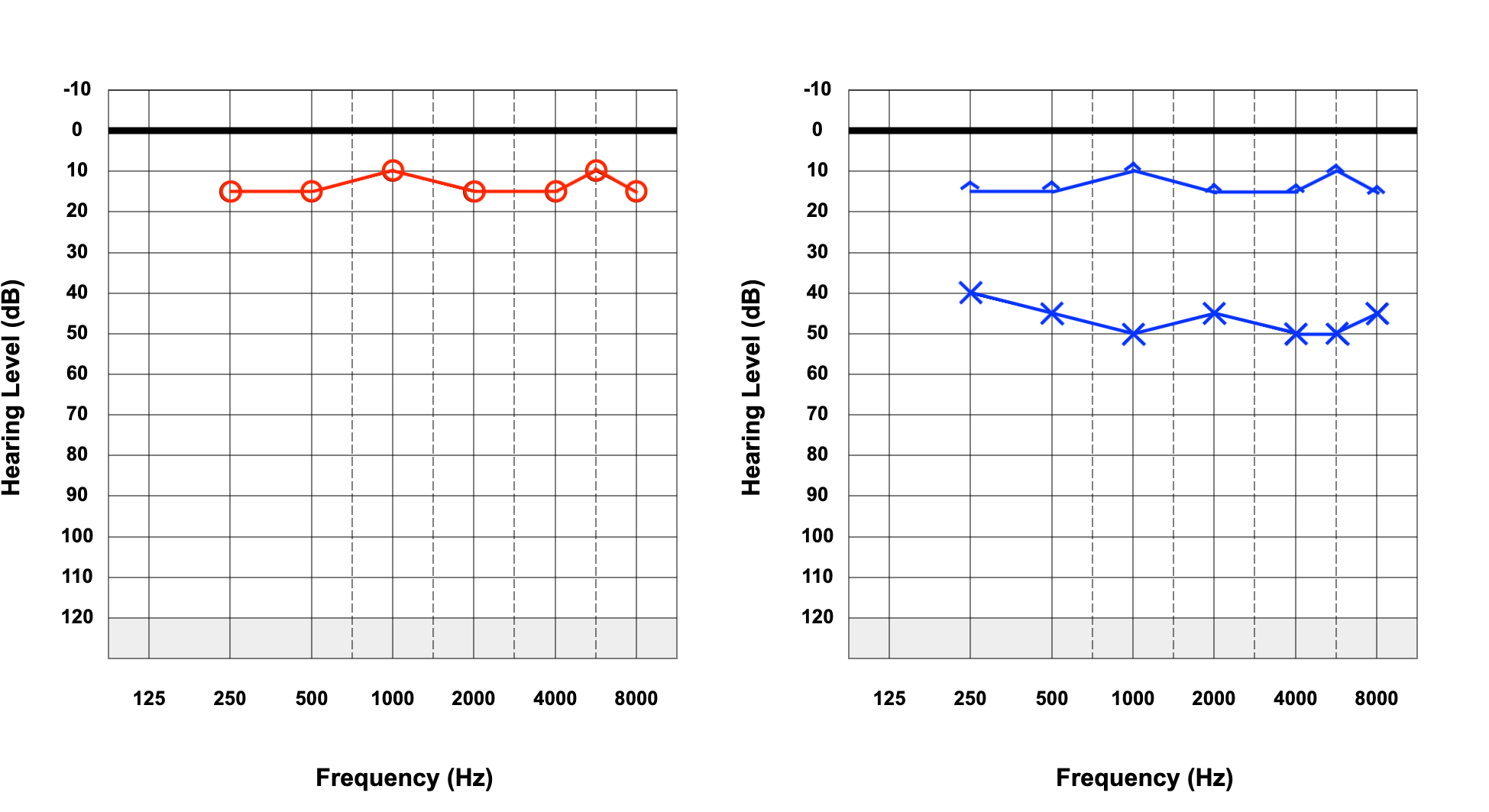 <p>Left-Sided Hearing Loss. Audiogram reveals left-side hearing loss with air conduction and unmasked bone.</p>