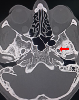 Foramen ovale