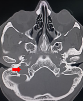 Jugular foramen