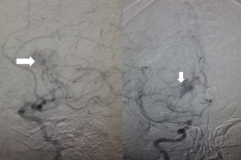 Angiographic findings in Moyamoya disease