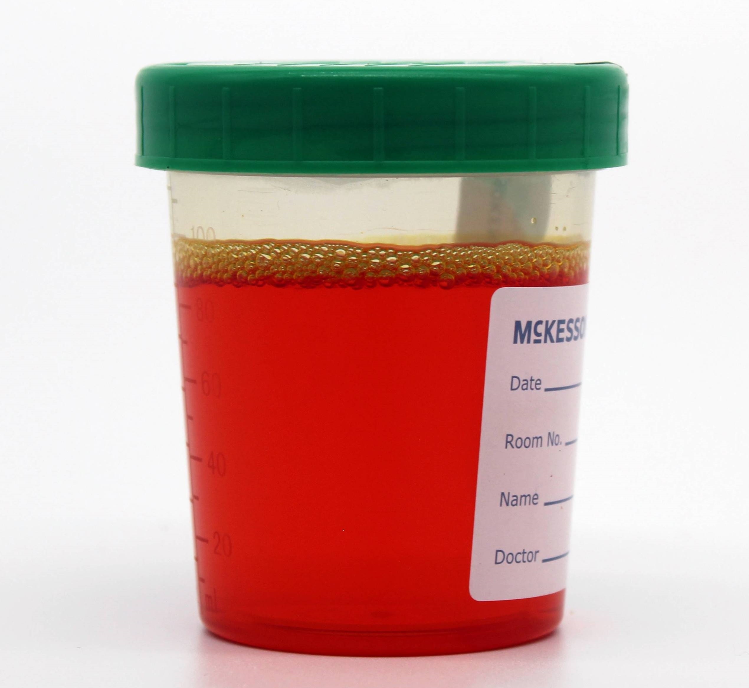 Urine colored with Phenazopyridine