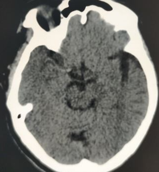 <p>Right-Sided MCA "Cord Sign"&nbsp;Harbingering Acute Infarction</p>